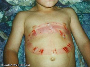 art.entrapment.injury.safekids.jpg